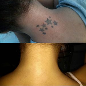 tattoo removal near me