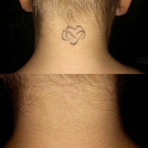 tattoo removal near me