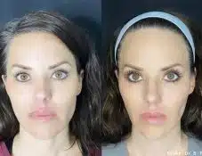 anti aging skin treatments winter park med spa