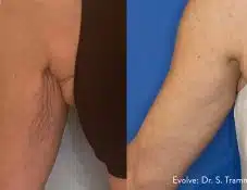 bat wing arm skin tightening