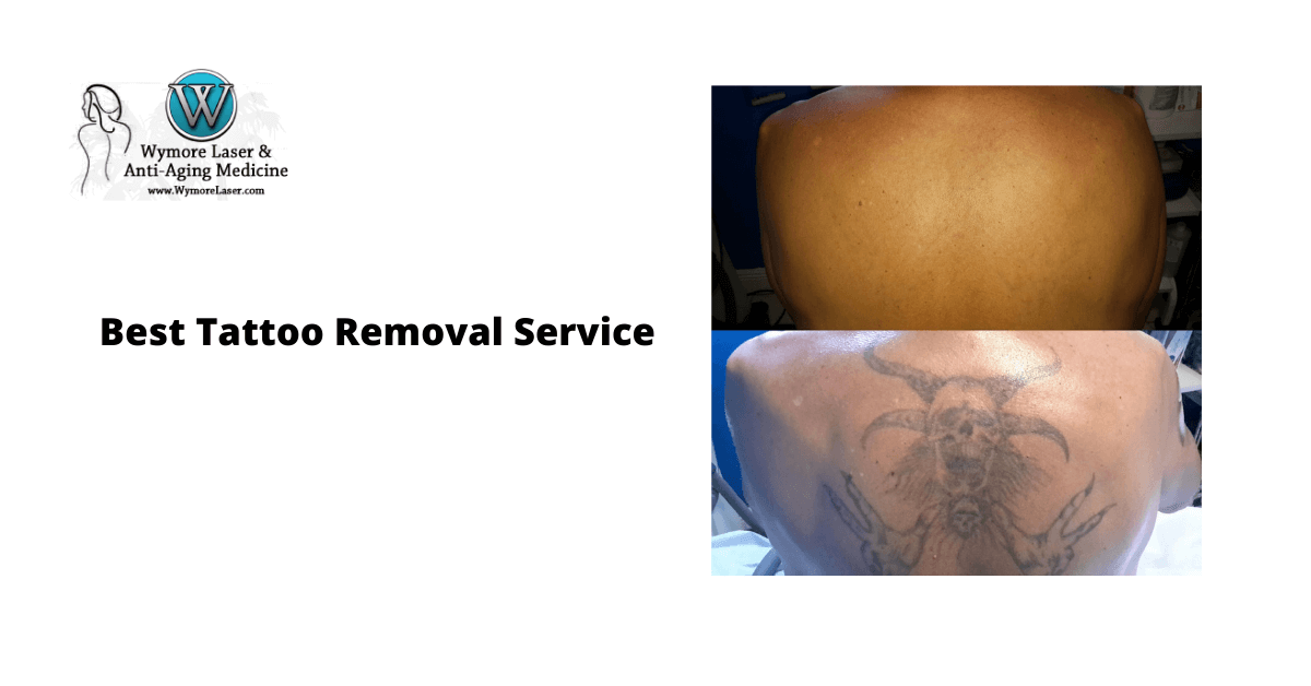 best tattoo removal around Orlando