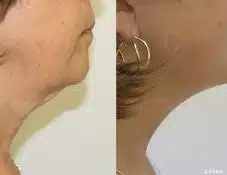 skin tightening winter park med spa
