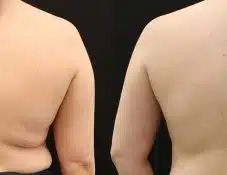 body sculpting love handles before and after