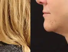 jaw contouring winter park