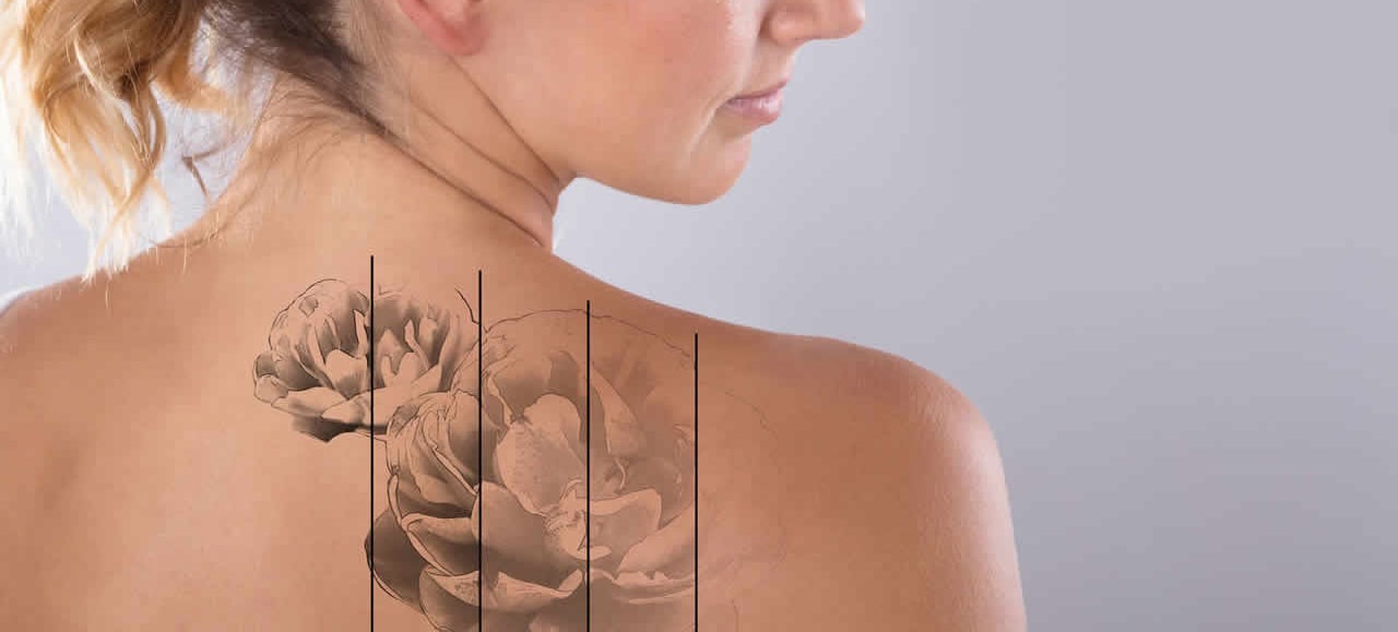 tampa bay tattoo removal