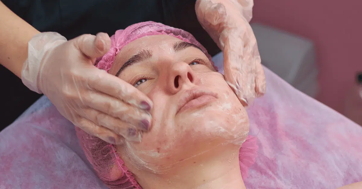 Chemical peels Chemical peels