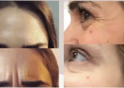 Dysport before and after