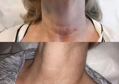 neck microneedling anti aging winter park
