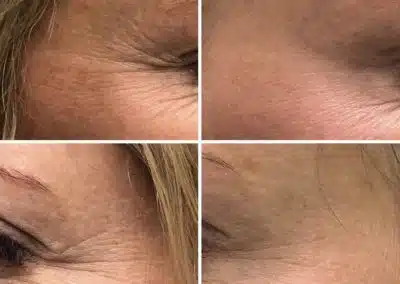before and after botox