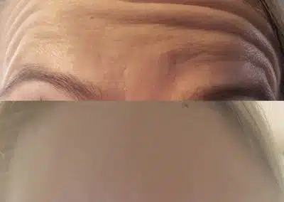 Botox injections