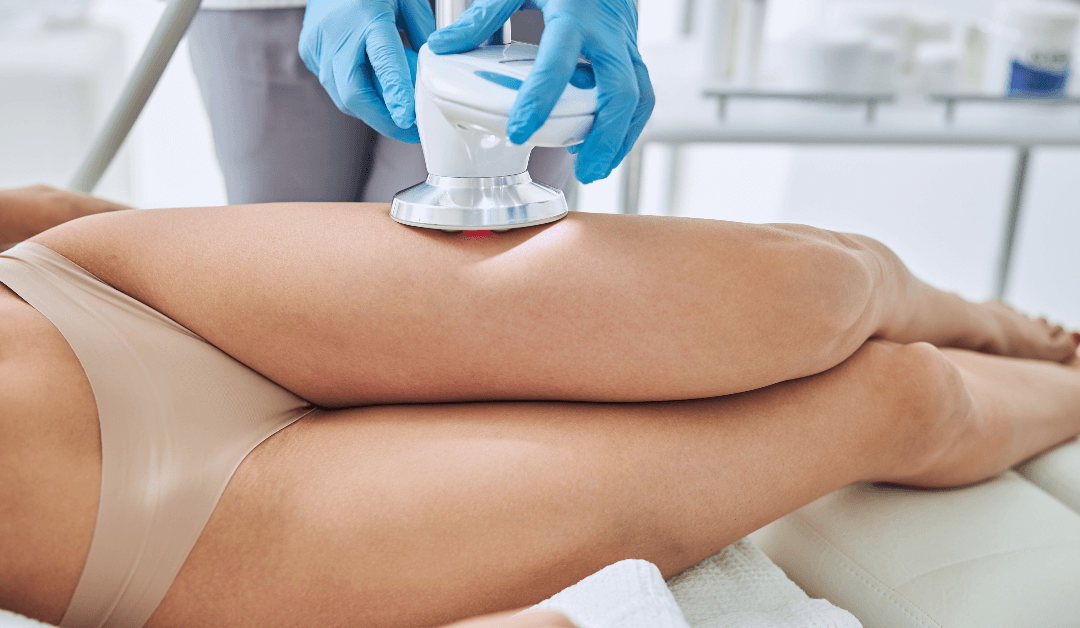 Laser Cellulite Treatment: What You Need to Know