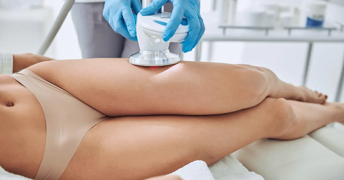 Orlando CoolSculpting cellulite treatment