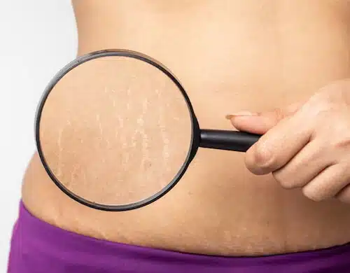 stretch mark Treatment | Stretch Mark removal in Orlando