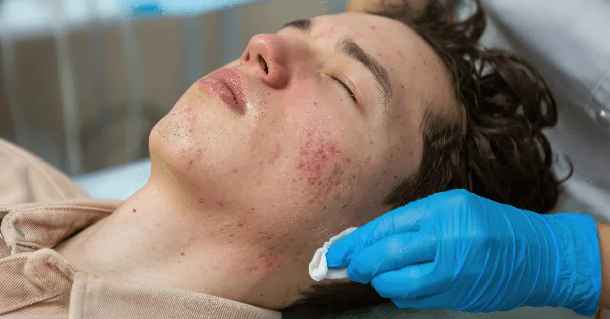 Sun Damage and Redness Laser Treatment