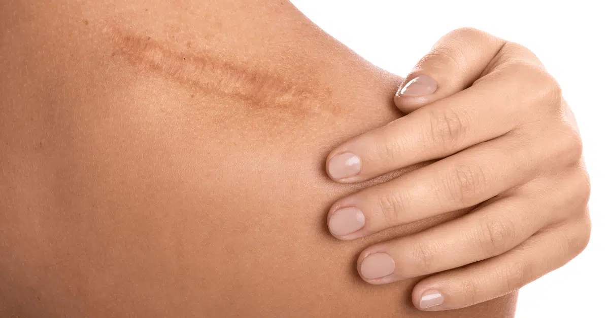 Laser Scar Treatment near me