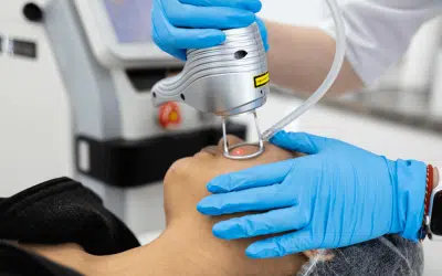 Pico Laser vs. Chemical Peels: Which is Right for Your Skin?