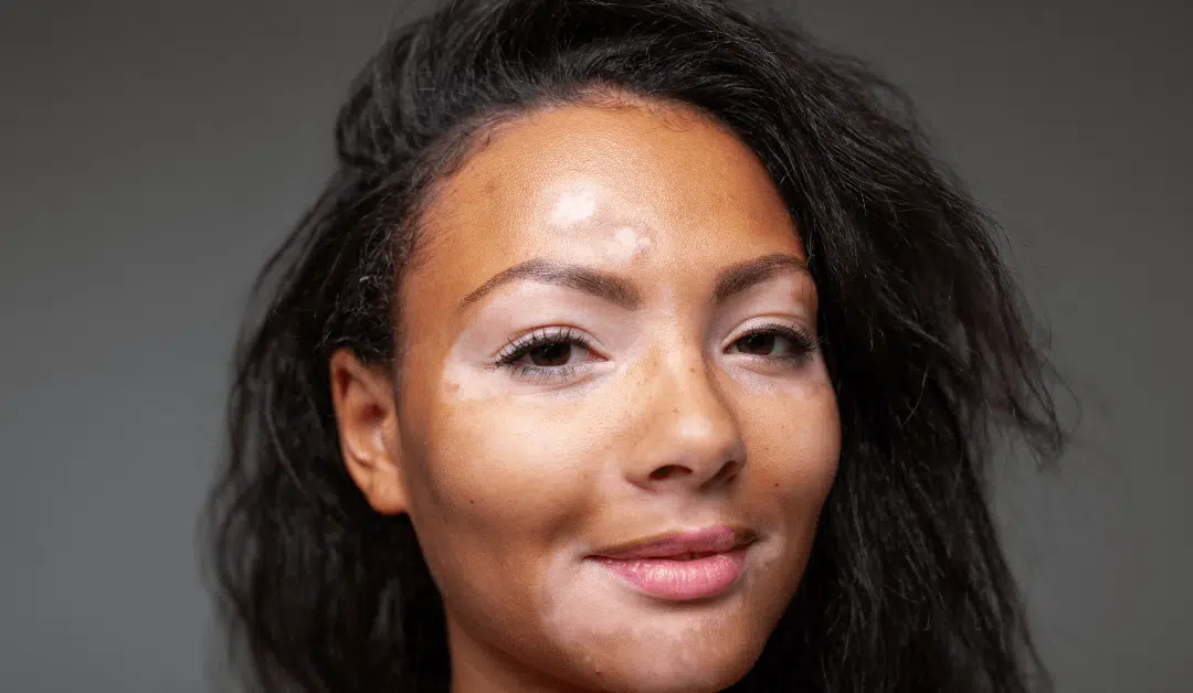 Combating Hyperpigmentation: IPL Treatment For Dark Spots