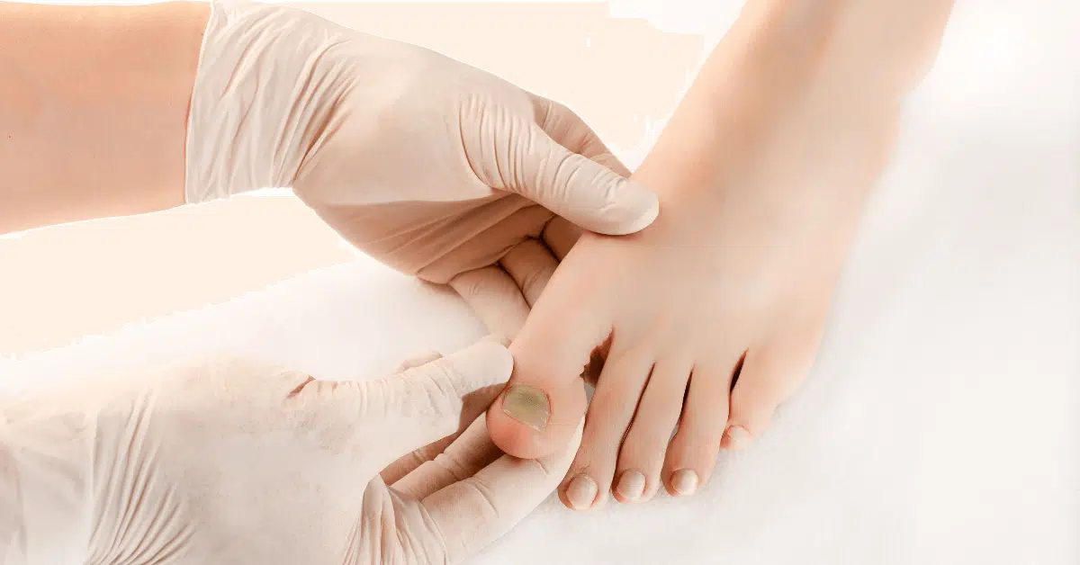 toenail fungus