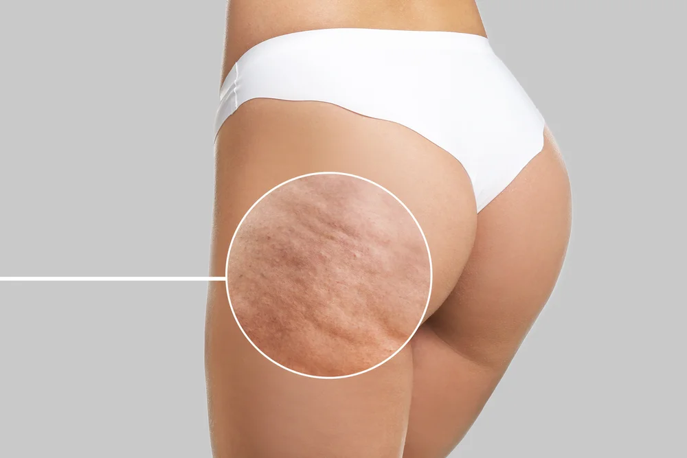 How can Laser for Cellulite Removal Smoothen Your Skin?