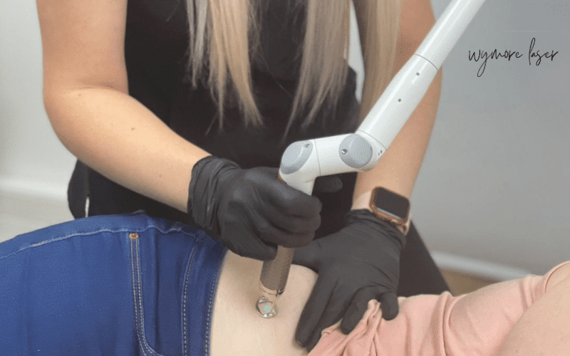 Stretch Marks Removal