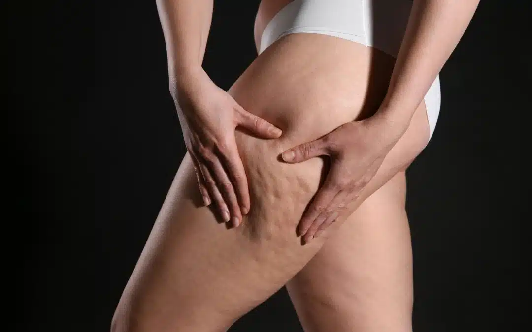 Laser Treatments For Cellulite