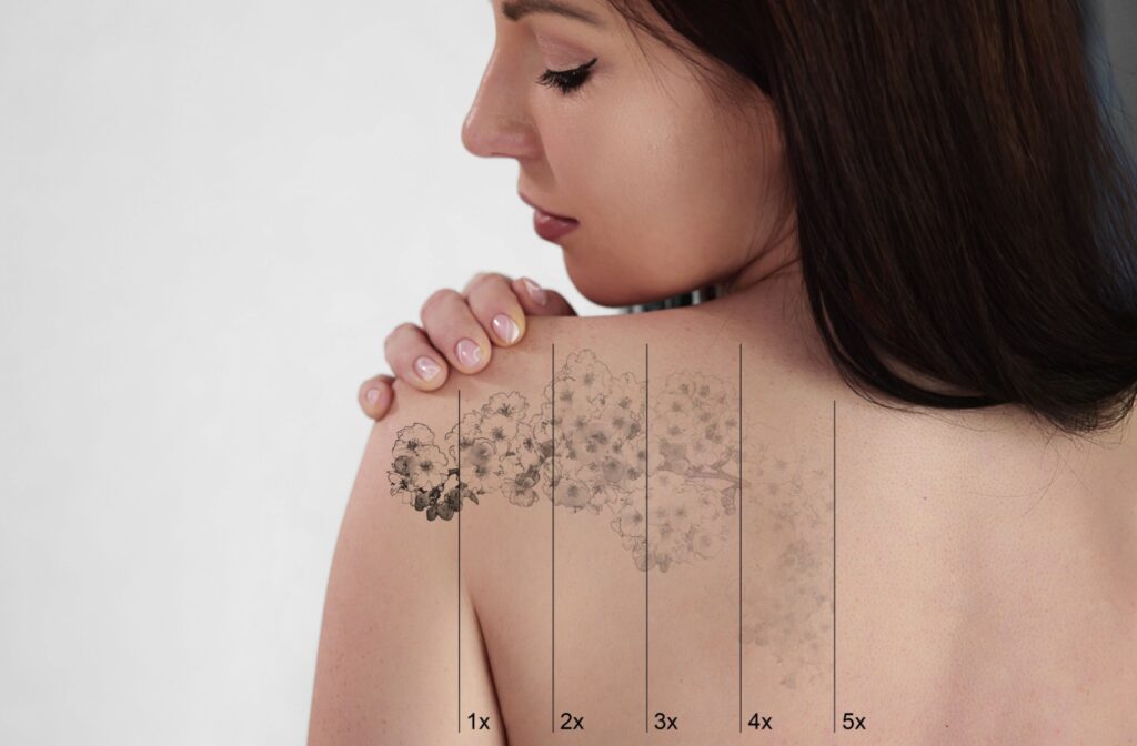 orlando laser tattoo removal