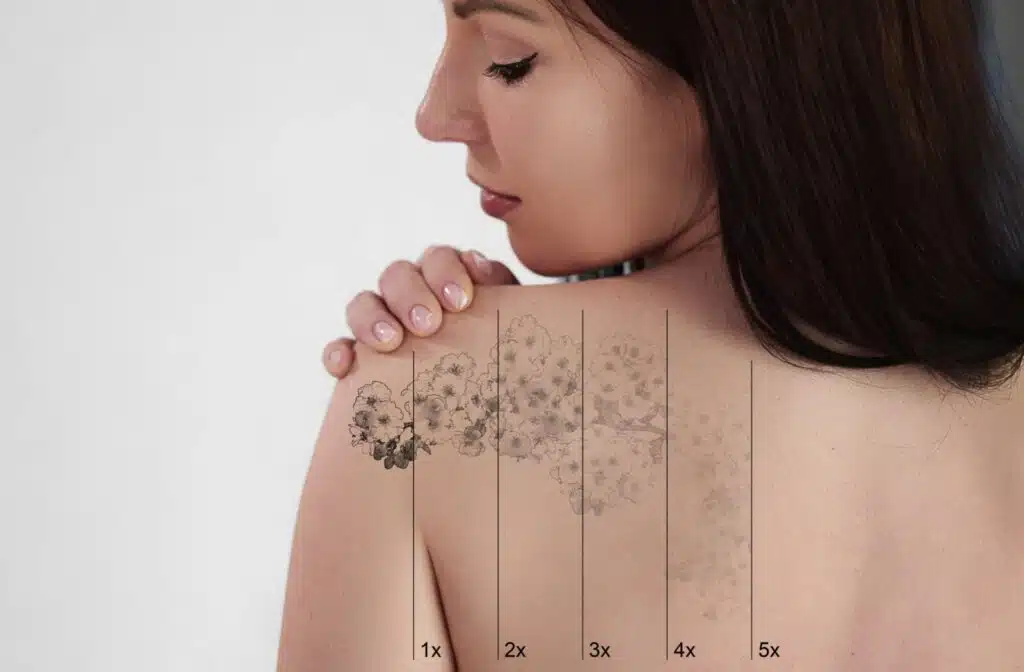 orlando laser tattoo removal