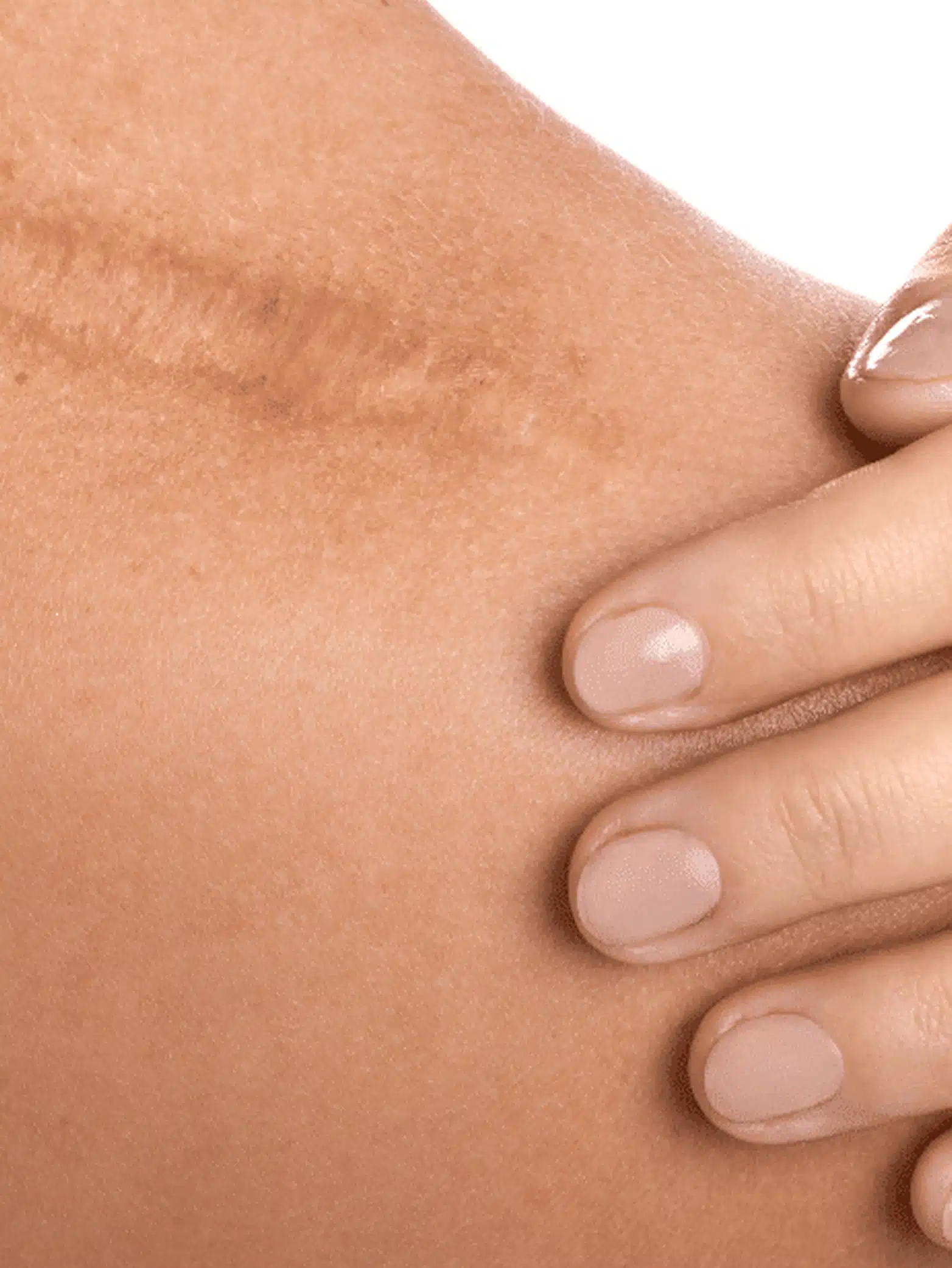Scar Treatment