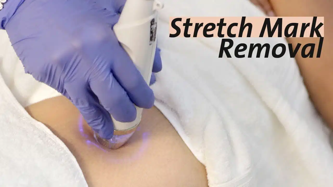 Laser Stretch Mark Removal Near Me