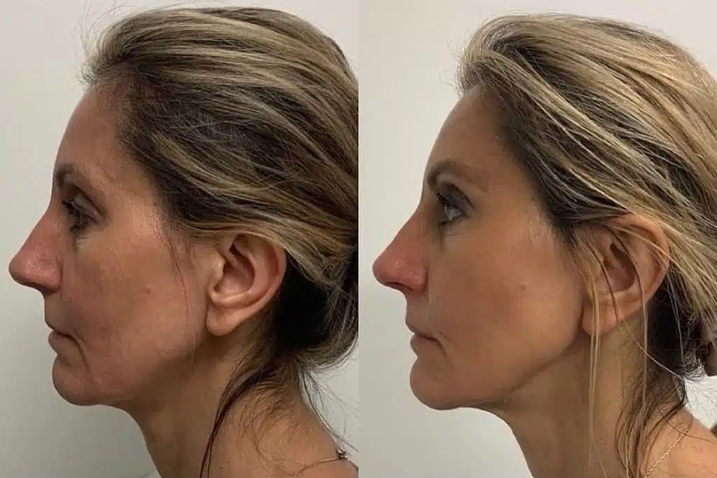 Skin Tightening Treatment Orlando