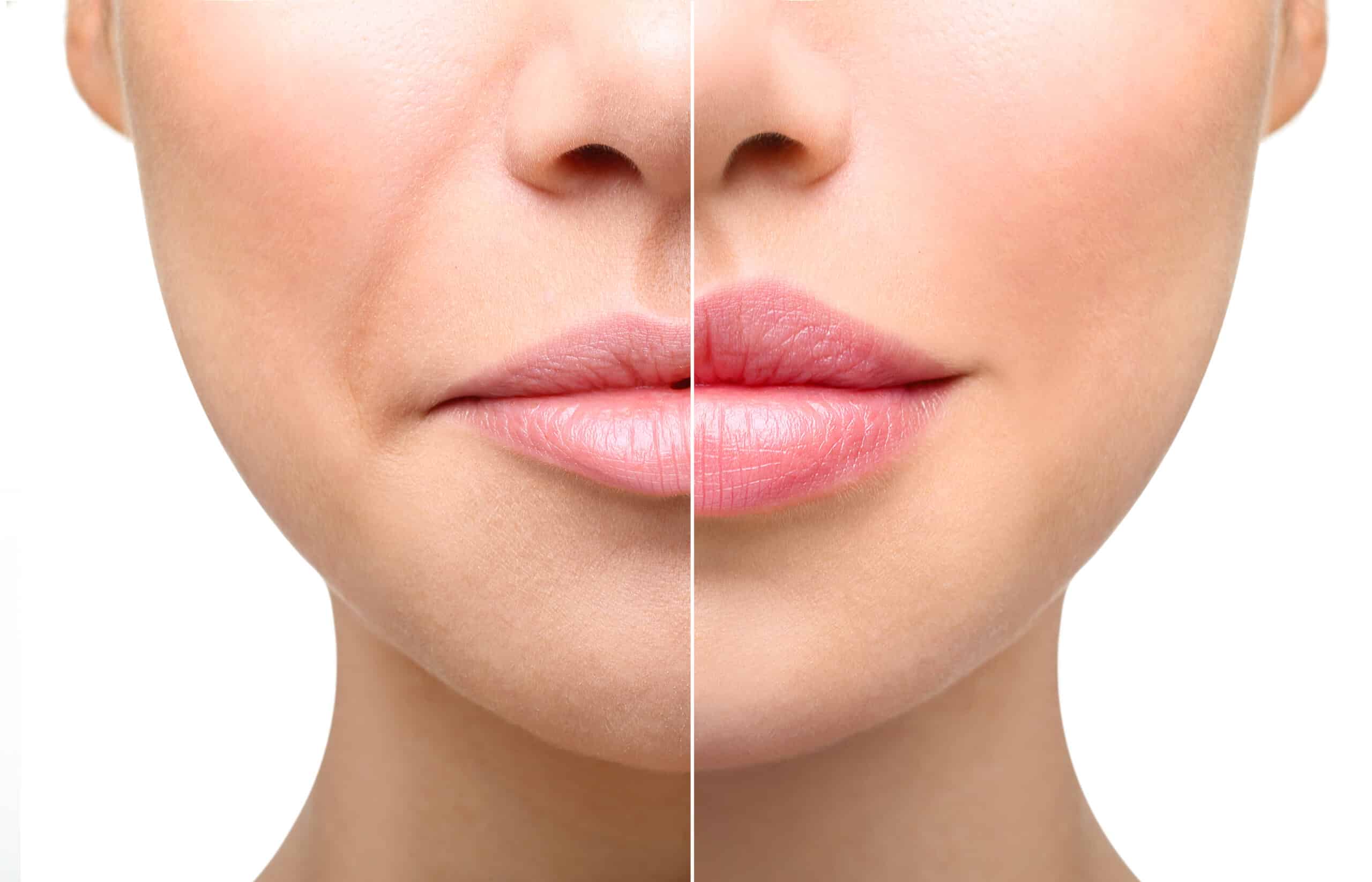 Lip Injections Near Me