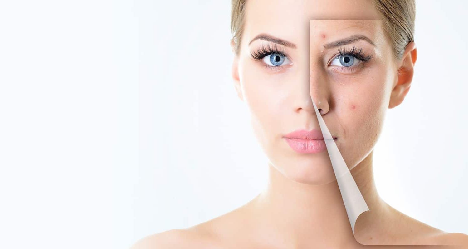 Laser Acne Treatment Florida