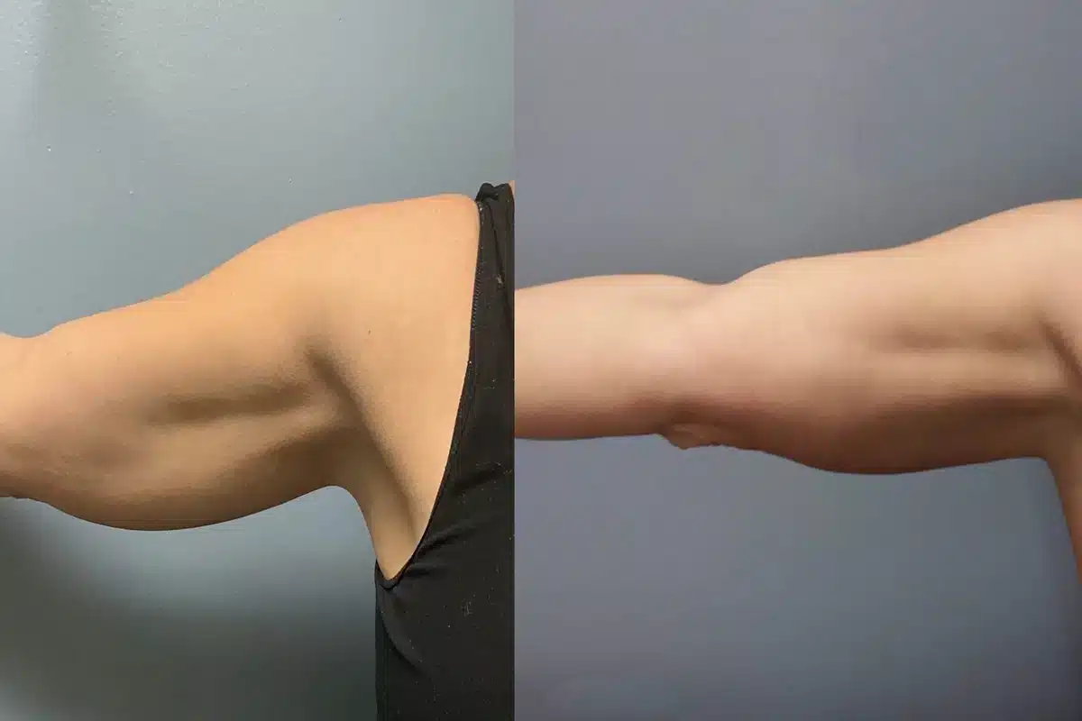 EVOLVE TRIM REMODELS SKIN