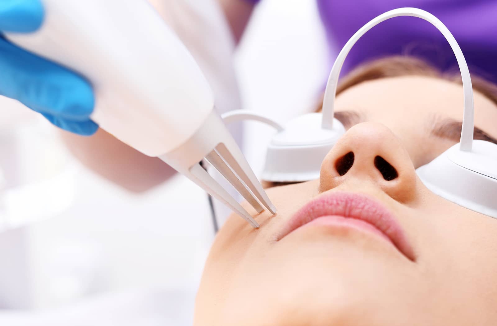 Laser Acne Treatment Florida
