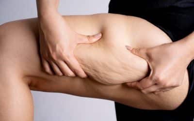 Cellulite Laser Reduction – Smooth, Firm, and Confident Skin