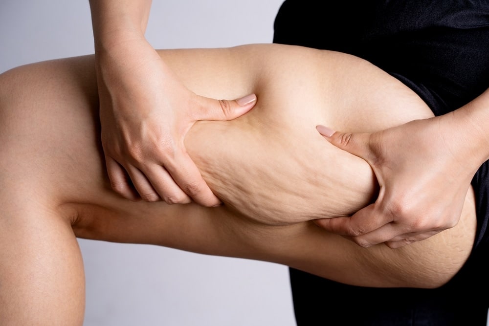 Cellulite Laser Reduction – Smooth, Firm, and Confident Skin