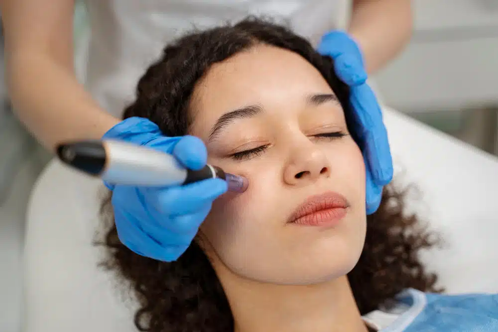 Micro Needling Orlando