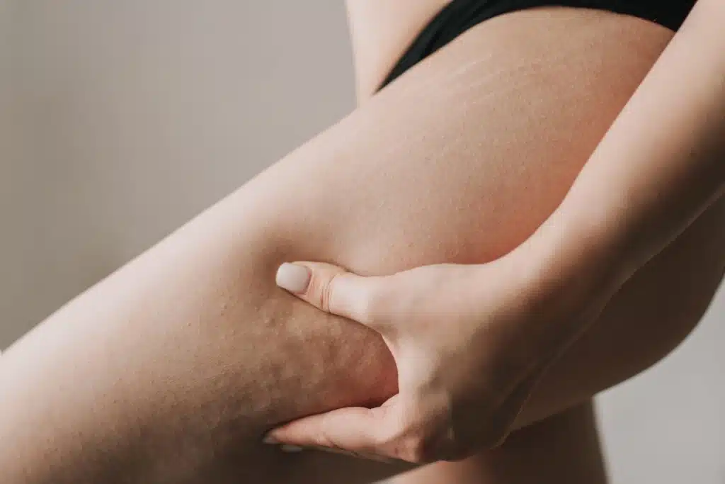 Laser Skin Tightening Cellulite