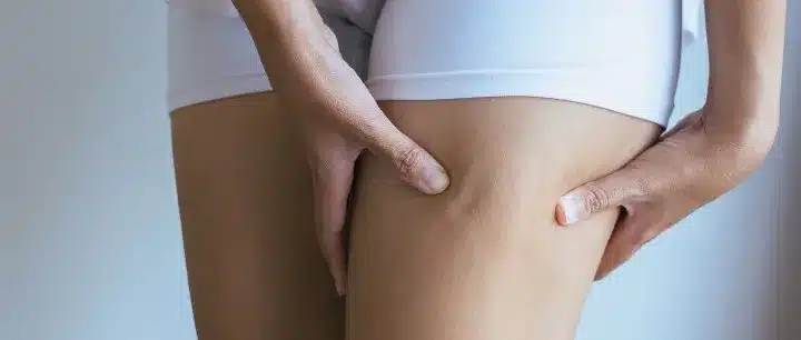 Laser Skin Tightening Cellulite