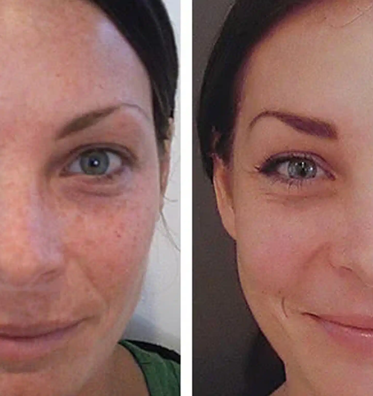 Chemical Peel Orlando F