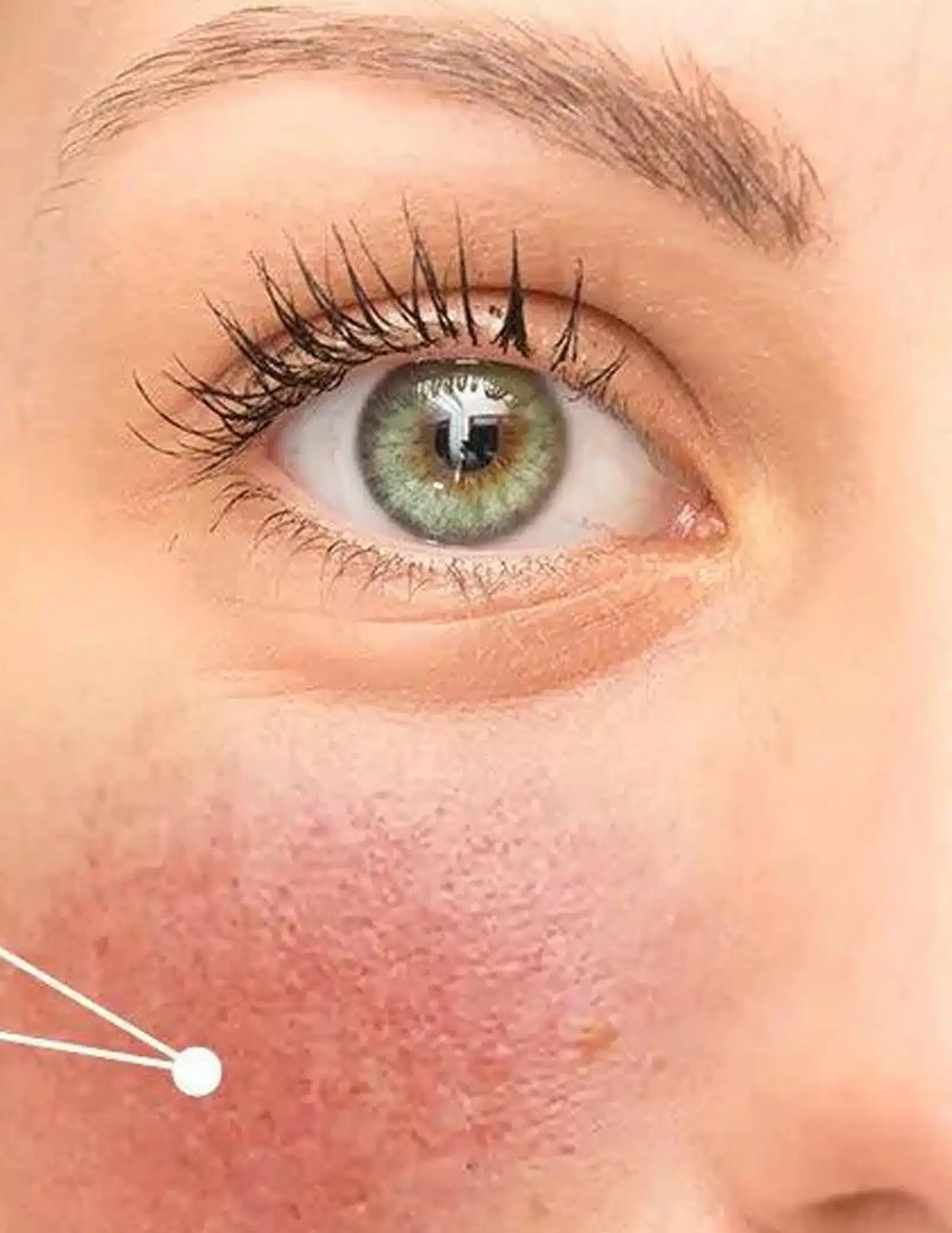 During the Treatment