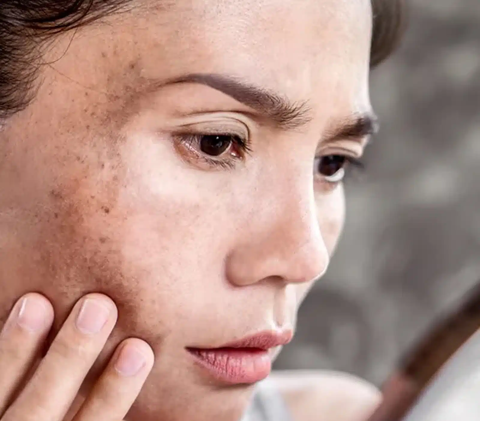 Fades Pigmentation and Sun Damage