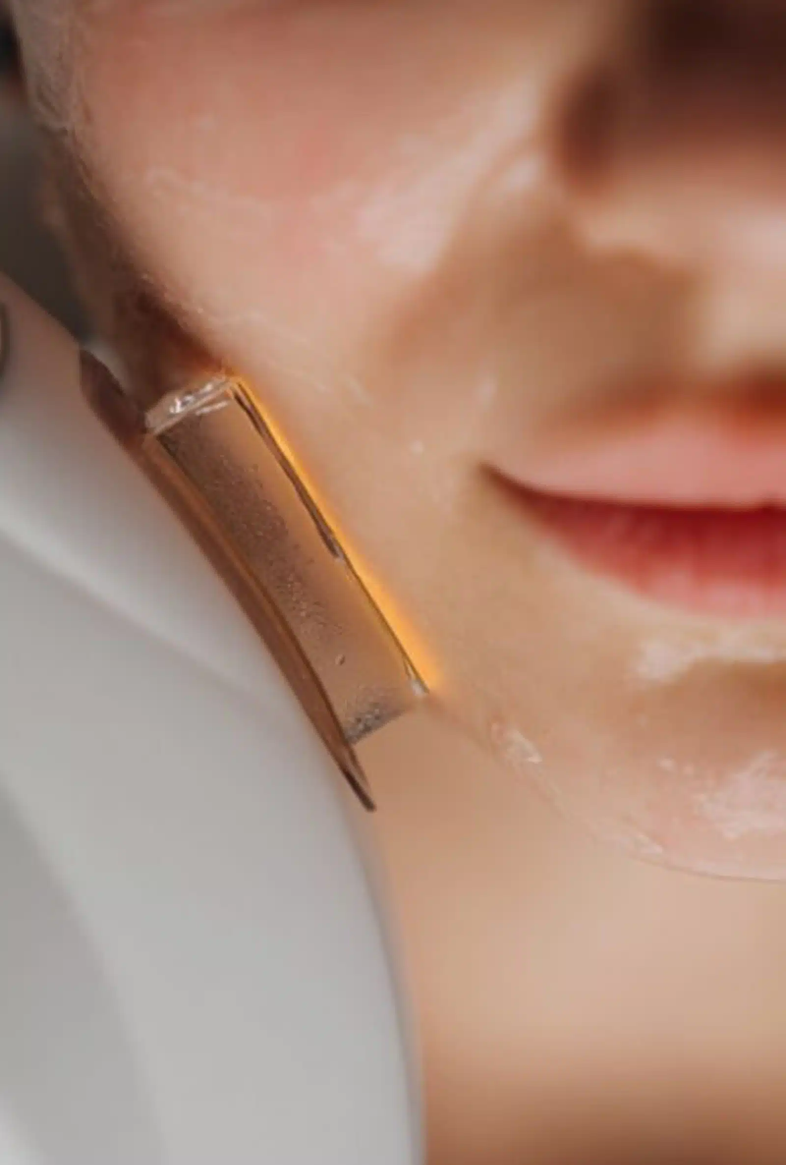 IPL Photofacial Procedure at Wymore Laser