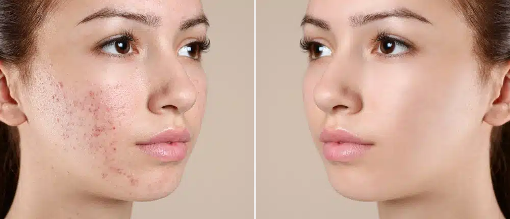 Laser Face Mark Removal