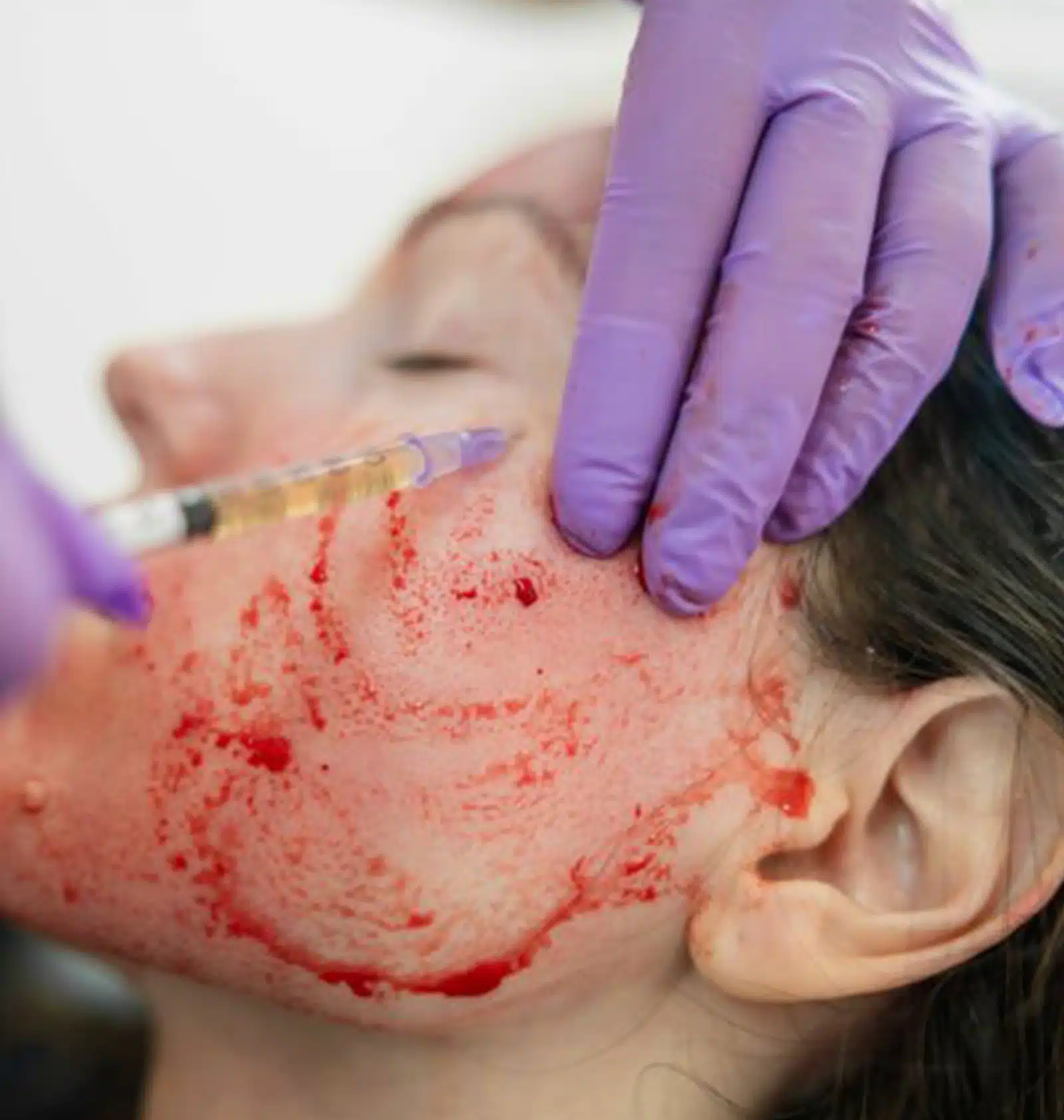 Platelet-Rich Plasma (PRP) comes from your own blood