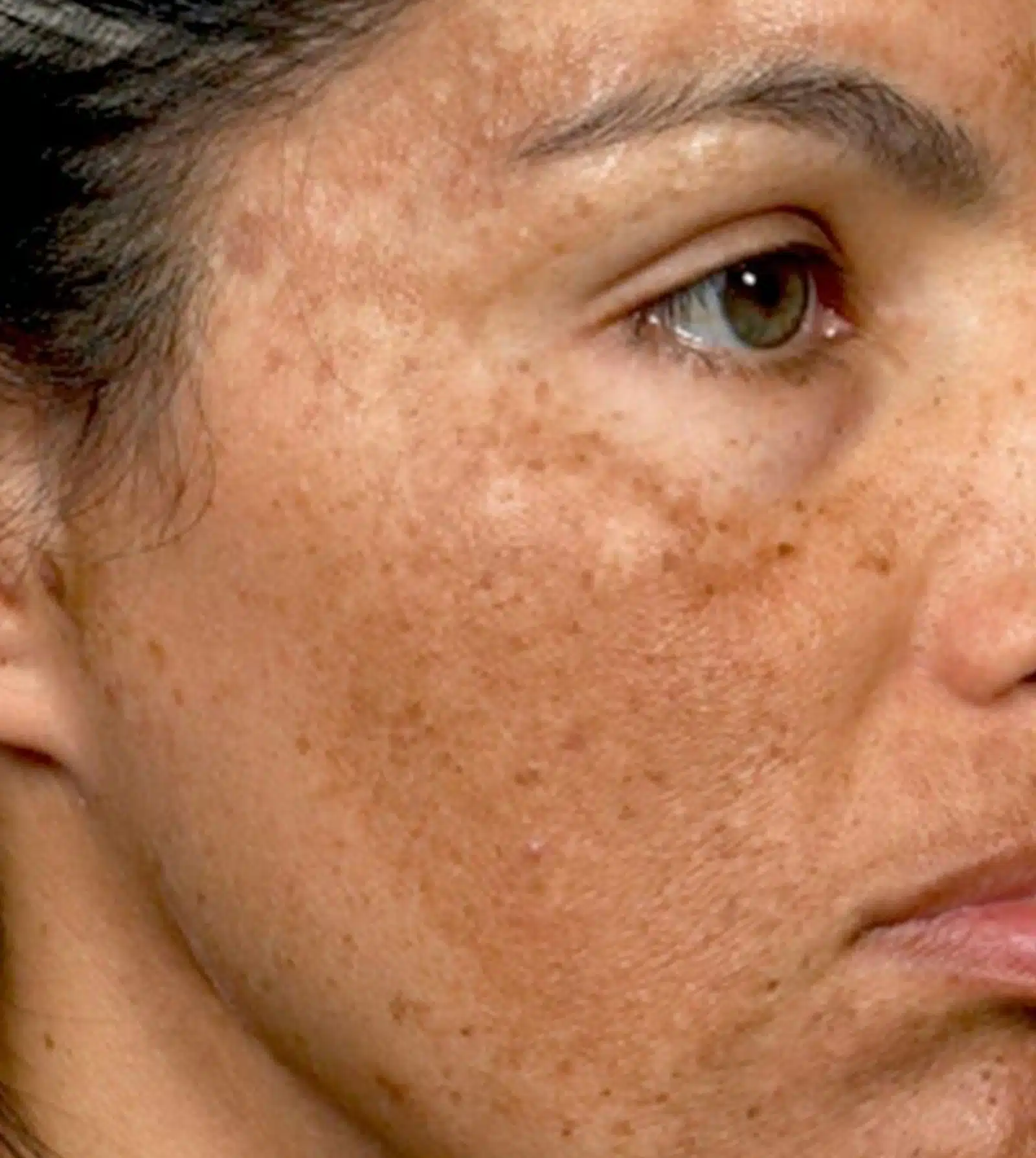 Common Triggers of Melasma
