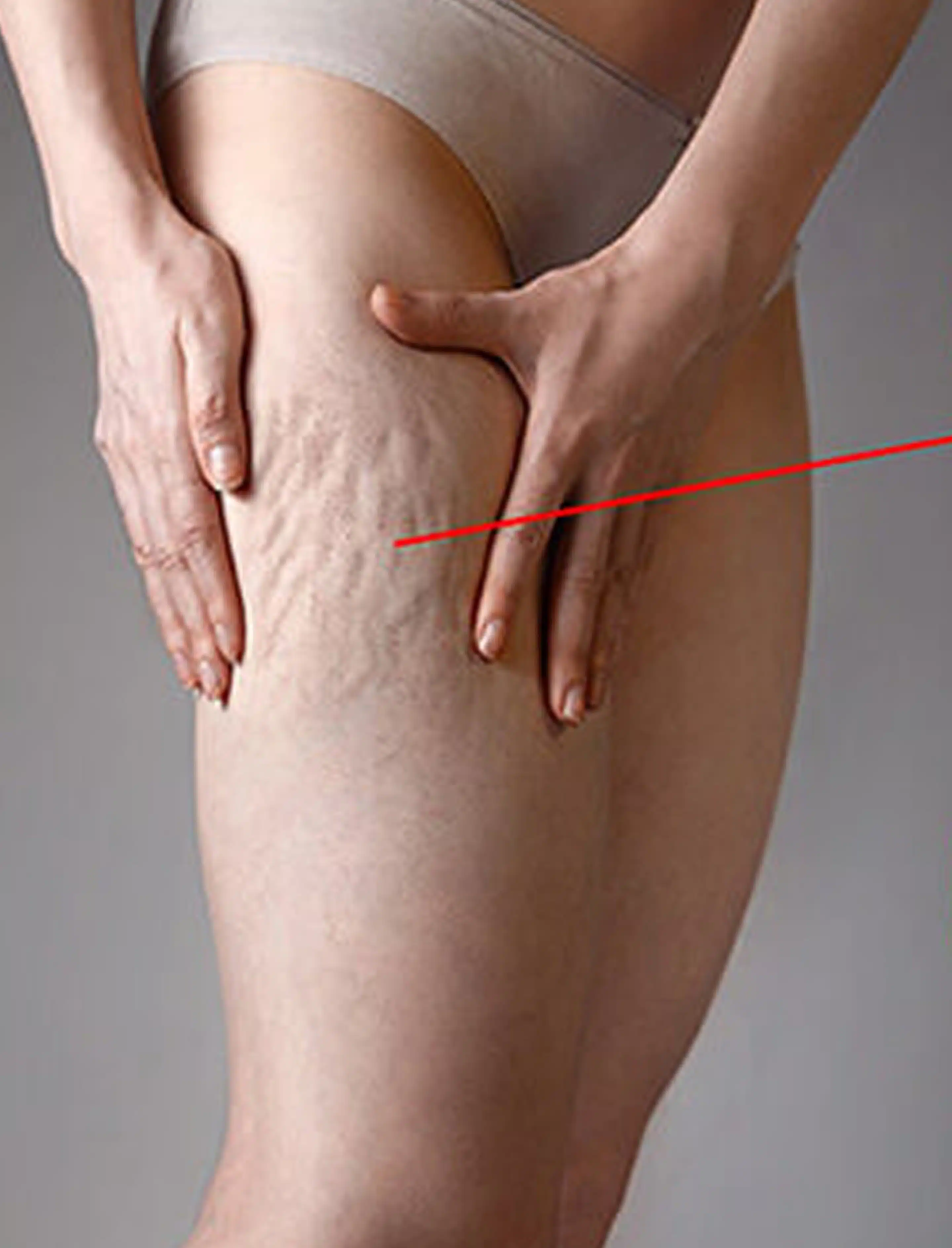Laser-Assisted Cellulite Reduction