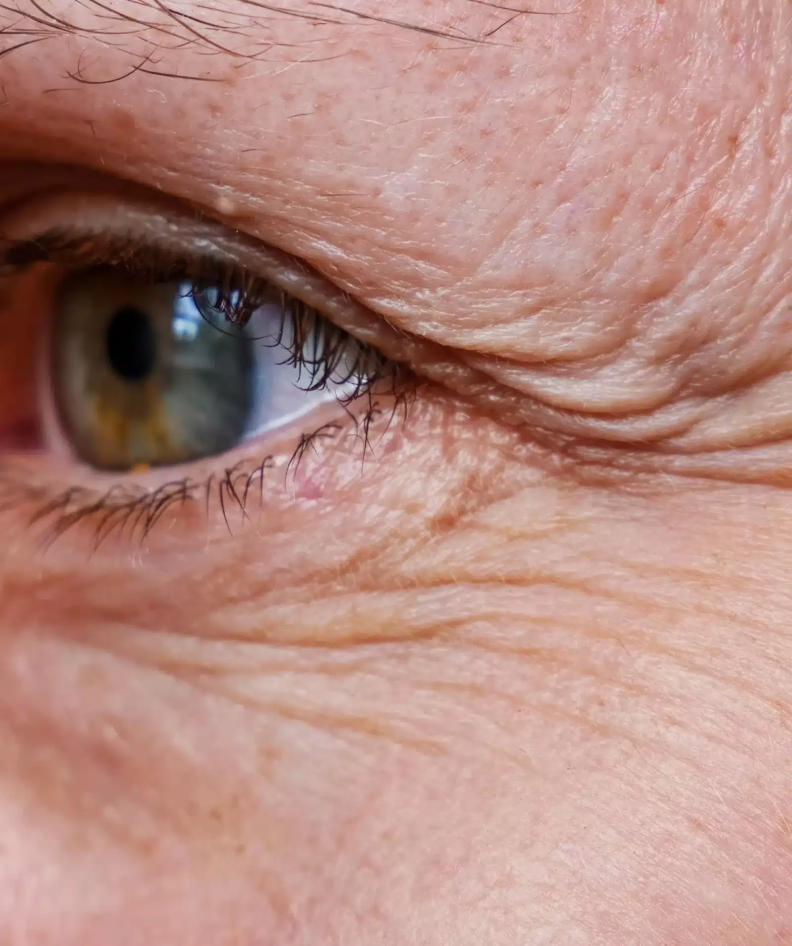 Types of Under-Eye Wrinkles