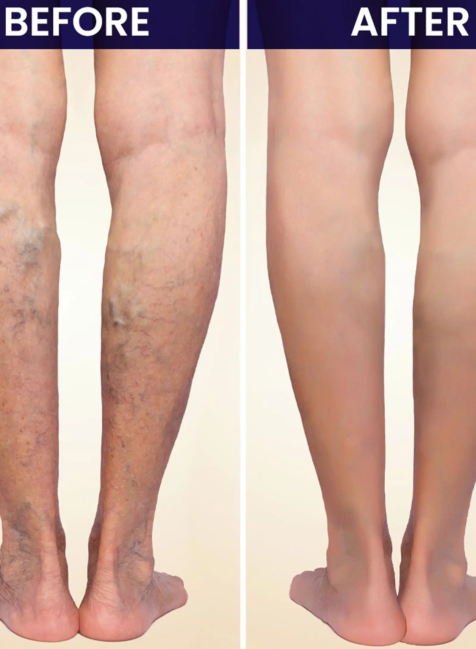 Bulging veins that worsen over time