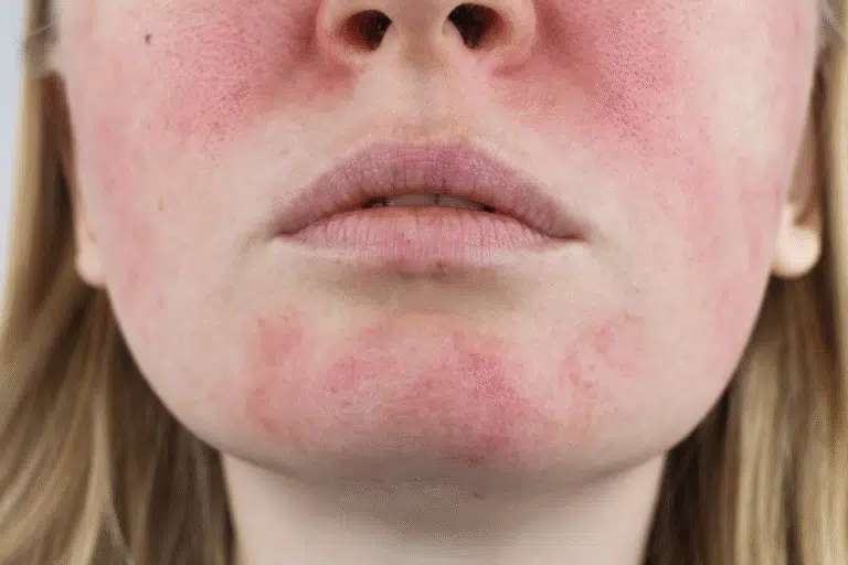 Effective Redness Treatment Winter Park